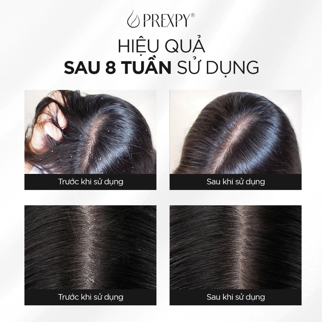 Serum Sạch Gàu Prexpy